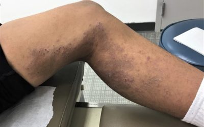 Atopic Dermatitis