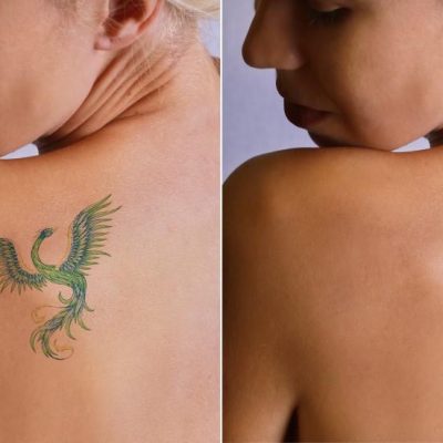Tattoo Removal New