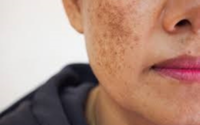 melasma